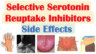 SSRI Antidepressant Side Effects amp Why They Occur  Fluoxetine Paroxetine Sertraline Citalopram [upl. by Kuehn]