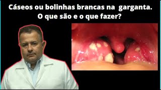 Cáseos ou bolinhas brancas na garganta O que são e o que fazer [upl. by Mutz63]