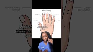 What Your Nails Say About Your Health Is It Nail Clubbing nails nailclubbing [upl. by Hynda99]