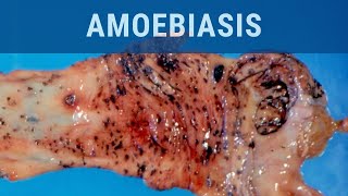 Amoebiasis  Pathology mini tutorial [upl. by Maurise73]