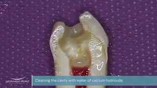 Pulpotomy by using calcium hydroxide [upl. by Keon]