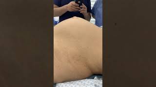 Diastasis de rectos y hernia umbilical antes de la cirugía [upl. by Cul]