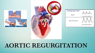 Aortic Regurgitation  Water hammer pulse  RHD [upl. by Cyma]