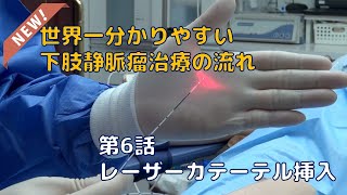 【新・世界一分かりやすい 下肢静脈瘤 治療 の流れ】6 レーザーカテーテル 挿入 [upl. by Iams468]