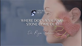 Where does a salivary stone come out [upl. by Eisnyl]