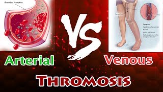 Arterial Thrombosis Vs Venous Thrombosis  Clear Comparison [upl. by Enael293]