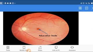 Macular hole in Hindi macularhole [upl. by Varin]