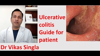 Ulcerative colitis Treatment and Symptoms अल्सरेटिव कोलाइटिस In Hindi Dr Vikas Singla [upl. by Feledy828]