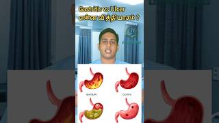 அல்சர் இரைப்பை அழற்சி என்ன வித்தியாசம்Gastritis vs Ulcer differencePangastritisulcer gastritis [upl. by Akirdnas158]