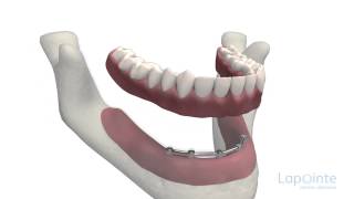 Prothèse complète sur implants  Centres dentaires Lapointe [upl. by Ahsinev901]