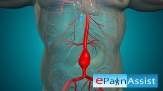 Open Abdominal Aortic Aneurysm and Endovascular Aneurysm Repair Surgery [upl. by Ahtanaram]