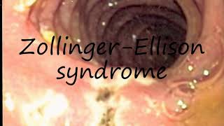 How to Pronounce ZollingerEllison syndrome [upl. by Dilaw635]