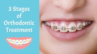 The 3 Stages of Orthodontic Treatment [upl. by Wendi40]