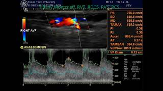 Radialcephalic Arteriovenous Fistula Duplex Evaluation AVF [upl. by Emlin998]