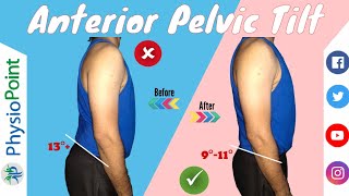 Anterior Pelvic Tilt Correction Exercises  The BEST EXERCISES  Simple Daily 4Step Progression [upl. by Eyla]