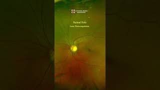 Retinal Tear Retinal Laser Photocoagulation eyes retinal eyedisease doctor eyedisorder [upl. by Ennaej]