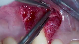 Coronally advanced flap and connective tissue graft [upl. by Sisi229]