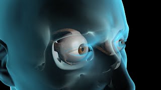 Glaucoma Surgery [upl. by Dylane431]