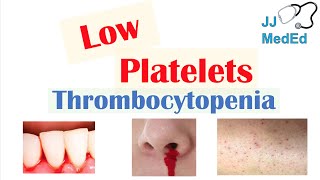 Thrombocytopenia  Signs and Symptoms and Approach to Causes [upl. by Lori]