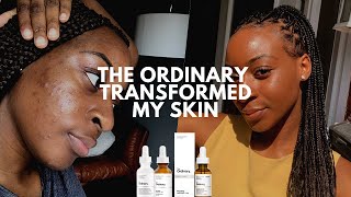 The Ordinary Skin Transformation Mandelic Acid Cleared My Acne  xoreni [upl. by Onitsoga274]