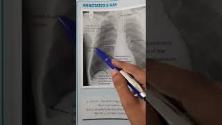 Atelectasis vs Pneumothorax atelectasis pneumothorax [upl. by Liddle]