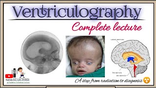 Ventriculography special investigation Ventriculography complete procedure in hindi [upl. by Annod]