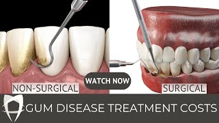 Periodontal disease  Periodontitis  Gingivitis  Treatment Fees [upl. by Kono824]