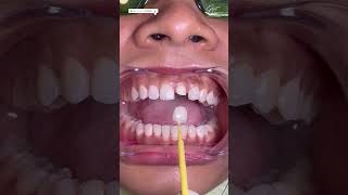 Dental Capping Treatment  Dental Crown Procedure Front Teeth zirconiacrown dentalcrowns shorts [upl. by Etnuad]