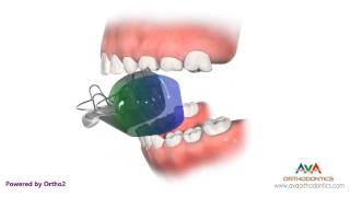 Orthodontic Treatment for Overjet Overbite  Bionator Appliance [upl. by Hurd804]