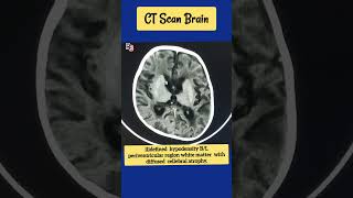 ill defined hypodensity BL periventricular region ctscan cva radiology [upl. by Ainex]