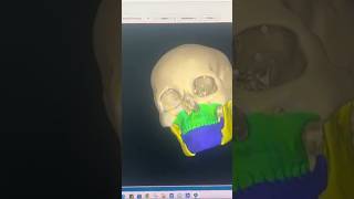 Best 3 D Planning before Bimax Orthognathic Surgery at Richardsons Face Hospitals [upl. by Auginahs]