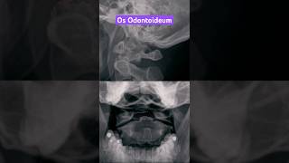 Os Odontoideum shorts radiology xray anatomy [upl. by Omsare842]