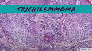 Trichilemmoma 5Minute Pathology Pearls [upl. by Berti550]