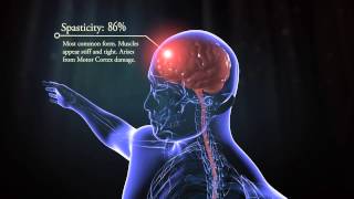 Types of cerebral palsy [upl. by Doralyn936]