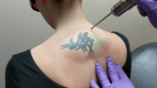 Laser Tattoo Removal  DermMedica [upl. by Decamp]