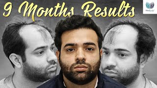 JawDropping 9Month Hair Transplant Transformation  Medlinks Hair Transplant Delhi [upl. by Thessa97]