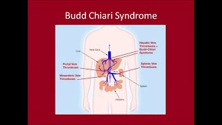 Management of Budd Chiari Syndrome [upl. by Epuladaugairam]