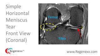 How to Read a Knee MRI for Meniscus Tears [upl. by Keifer254]