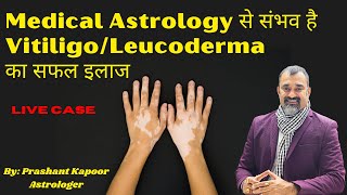 Medical Astrology से संभव है VitiligoLeucoderma का सफल इलाज  Prashant Kapoor [upl. by Aerdnua]