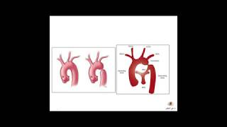 تضيق الشريان الأبهر  Coarctaion of the Aorta CoA  Dr Ali Alakhfash [upl. by Nitza117]