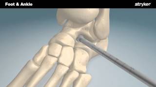 Stryker Foot and Ankle  SubFix™ Arthroeresis Implant Animation [upl. by Amoihc175]