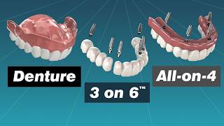 Alternative to Dentures Comparing Dentures Overdentures Allon4 and 3 on 6™ [upl. by Hayley]