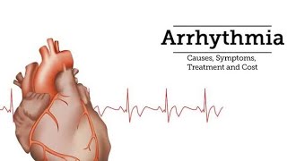 Supraventricular tachycardia SVT [upl. by Cuhp]