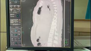 20F with Hydropneumothorax part 3 [upl. by Lotson357]