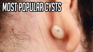 Top 5 Most Popular Pops amp Cysts [upl. by Rabbaj]