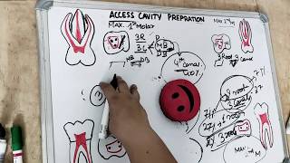 access cavity preparation  premolar amp molar [upl. by Eugenia]