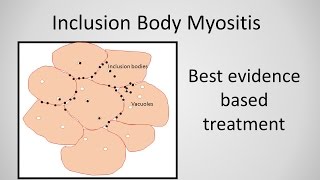 Inclusion Body Myositis Treatment [upl. by Denn461]