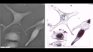 Lung cancer cells under 3D microscope [upl. by Oetsira]