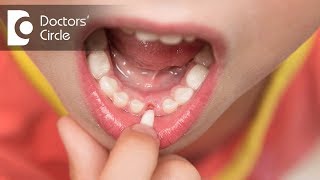 Why do childrens teeth fall out  Dr Raju Srinivas [upl. by Annhej491]