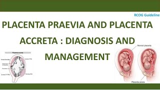 Diagnosis and Management of Placenta Praevia and Placenta Accreta RCOG Guideline [upl. by Puri998]